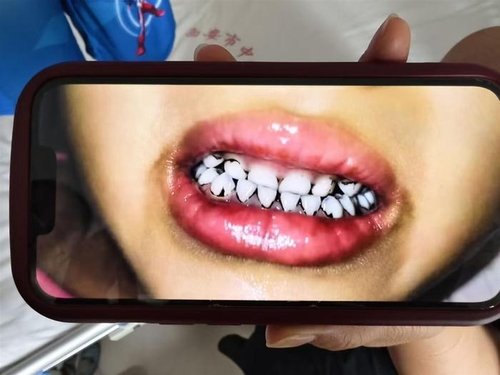 中 유치원 납 중독 사건의 충격적인 원인, 알고 보니...