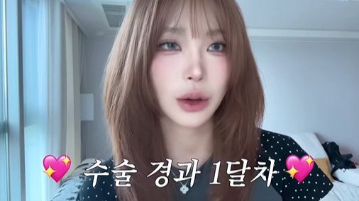 최준희, 윤곽 수술 후 "중안부 짧아지고 턱라인 깔끔…대만족"