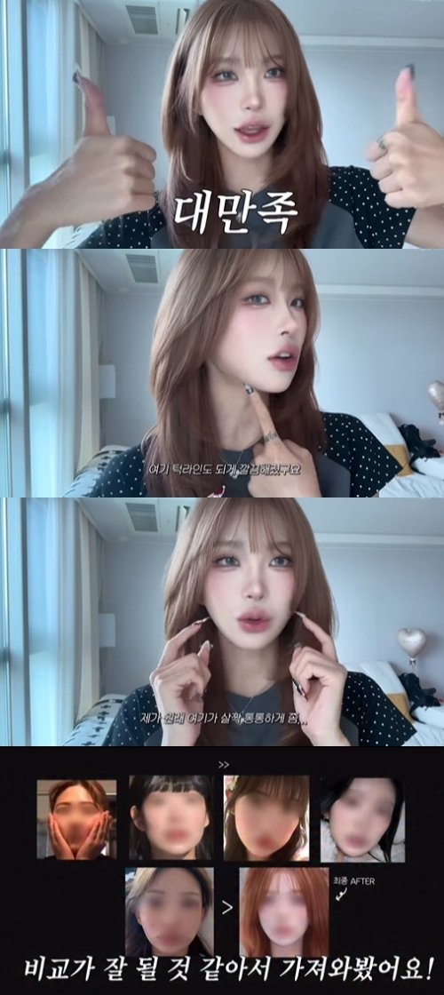 최준희, 윤곽 수술 후 중안부 짧아지고 턱라인 깔끔…대만족