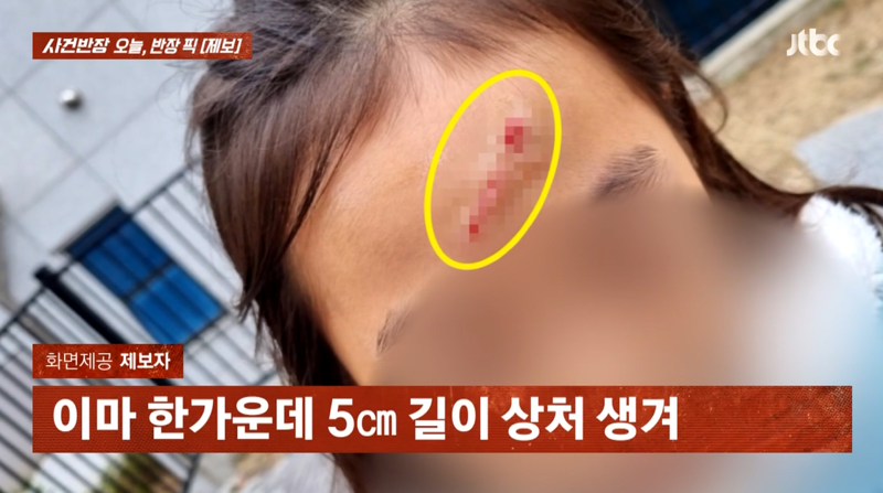 엘리베이터서 천장 구조물 추락하는 대참사... 초등생 여자아이 얼굴에 흉터 봤더니