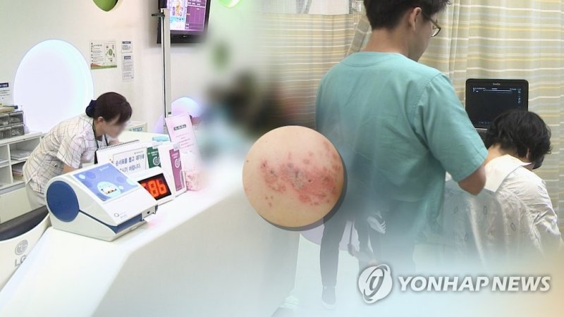 헤르페스 바이러스(HSV)에 의한 대상포진(CG) (출처=연합뉴스)
