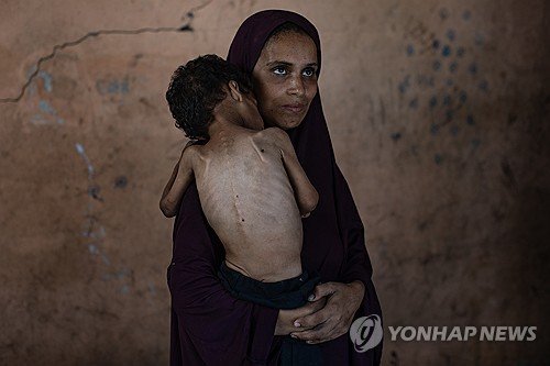심각한 영양실조 상태인 두살배기 아이를 안고 있는 여성 (출처=연합뉴스)