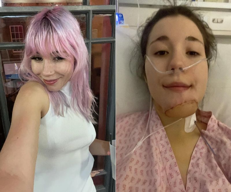 희귀암이 생겨 턱의 피부와 뼈를 제거한 뒤, 허벅지 피부를 이식해 턱에 다리털이 자랐다는 영국 여성. 출처=더 선