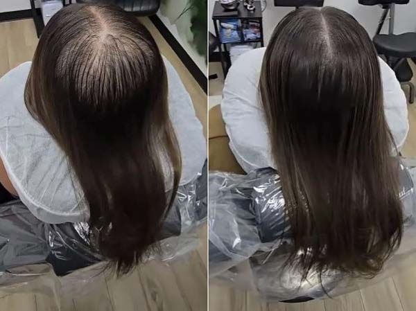 텅 빈 여성 정수리, 이 '시술' 받고 풍성…뭘 했길래  