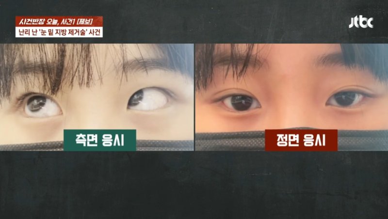 "두 눈이..." 성형수술 후 끔찍한 부작용에 절망한 여성