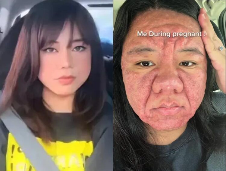 충격적인 얼굴 임신 후 확 변해... 실화에 충격