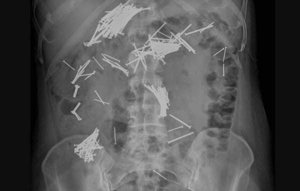 응급실 찾은 30대 여성, 몸 속서 뾰족한 '이것' 수십 개 발견 됐다는데