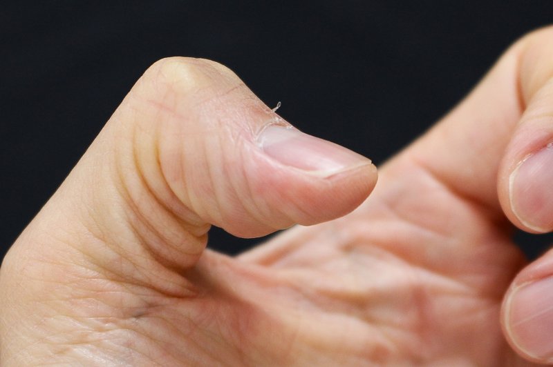 손톱 밑 거스러미 물어뜯다가 일어날 수 있는 일