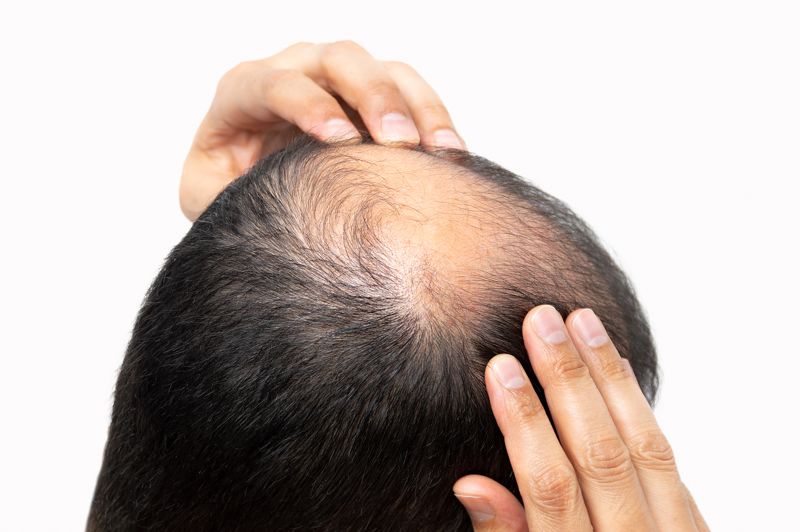 탄산 음료 자주 드시나요? 머리카락 조심하세요!