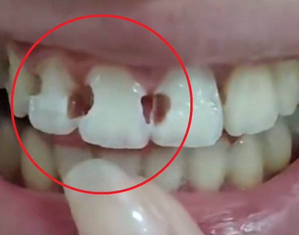 5년간 치아 교정 낀 20대女에 벌어진 끔찍한 사연