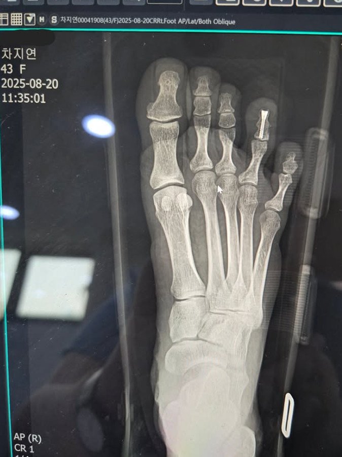 차지연, 발가락에 나사 박고 복귀…골절에도 공연 생각뿐