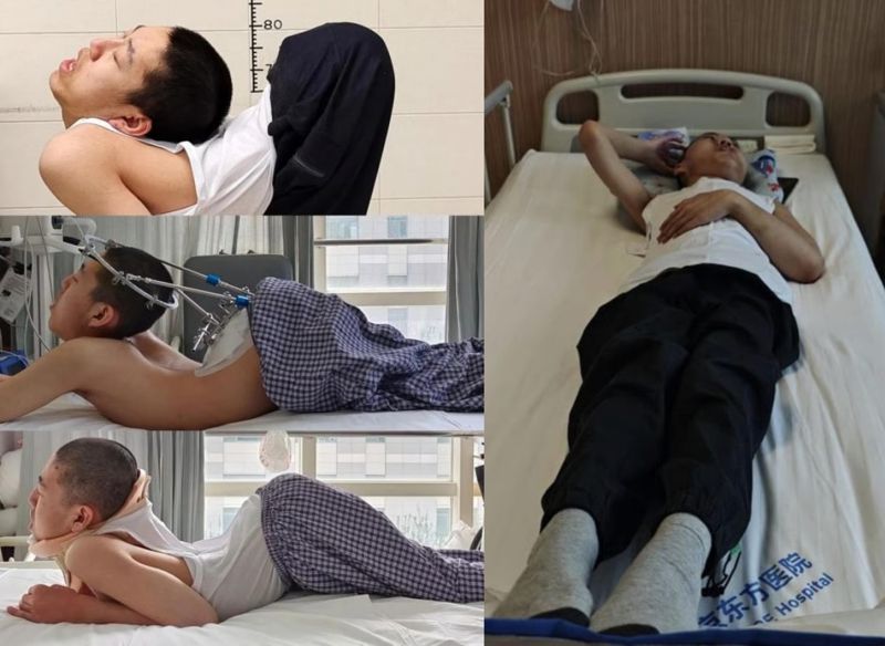 180도 꺾인 허리가 펴졌다…中 '폴더 소년' 기적의 결과