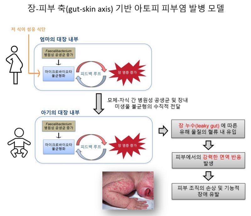 병원성 공생균과 식이섬유 부족에 따른 아토피 메이저 바카라사이트 홈런 발병 모델(한국연구재단 제공) /메이저 바카라사이트 홈런1
