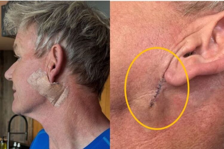 고든 램지 귀 옆에 꿰맨 자국..'이 암' 때문에 수술했다