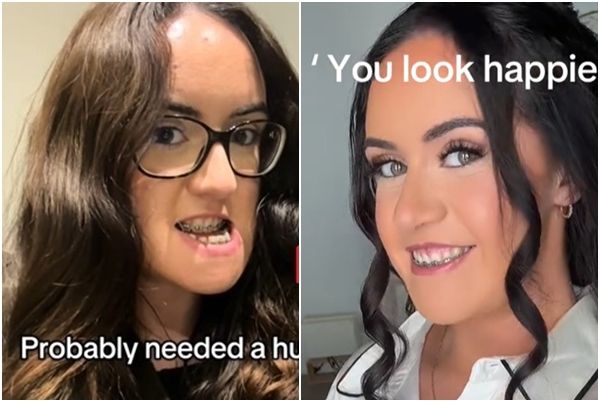 '주걱턱' 놀림 받던 女, 양악수술 받고 새로 태어났다