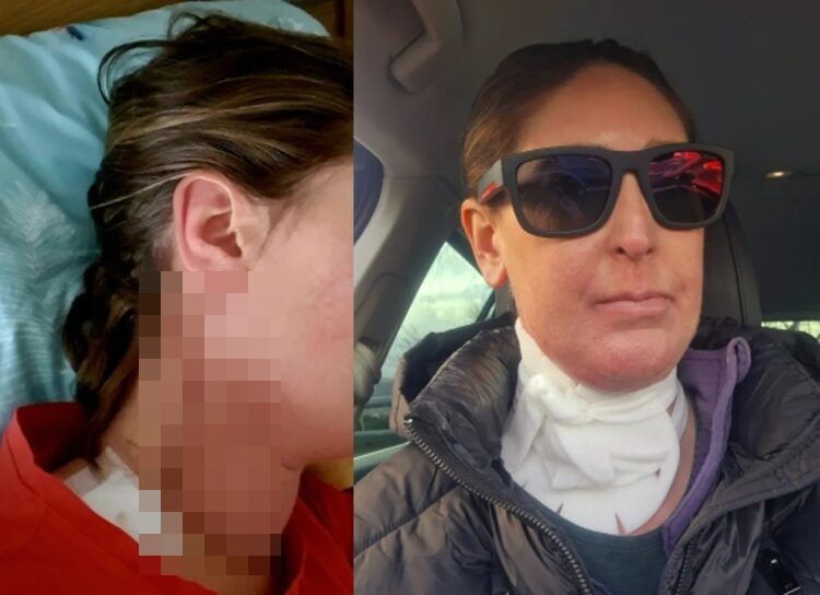 과자 먹다가 '혀암' 발견…혀 절제 수술까지 