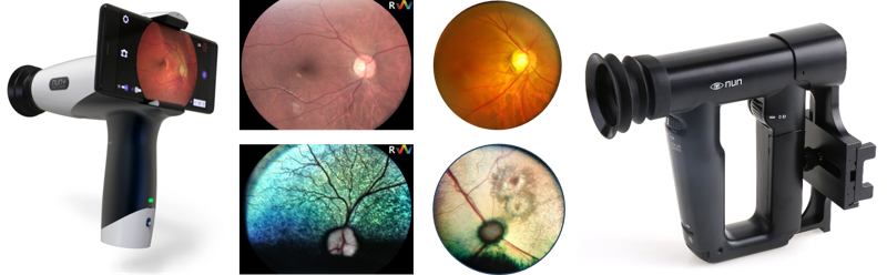 위키옵틱스의 휴대용 안저카메라 nun+. 원주의료기기산업진흥원 제공