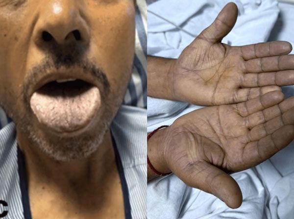 온라인서 보충제 구매해 먹은 50대 남성, 손과 혀가... 소름