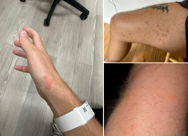 응급실 격리까지 당했는데…美마라토너의 병명은 의외의 '습진'