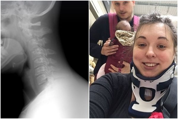 평범한 하품이 ‘악몽’으로…30대女 목뼈 골절 충격