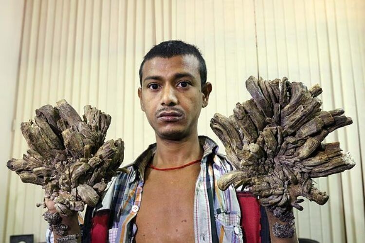 피부가 나무처럼 자란다... '나무인간 증후군'