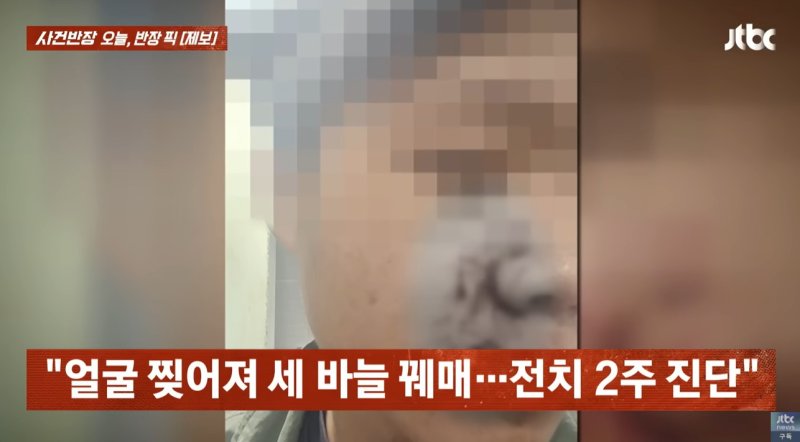 [서울=뉴시스] 싸움을 말리는 과정에서 A씨는 얼굴이 찢어져 세 바늘을 꿰매는 등 전치 2주의 부상을 입었다. (사진=JTBC '사건반장' 갈무리) 2025.09.25 *재판매 및 DB 금지
