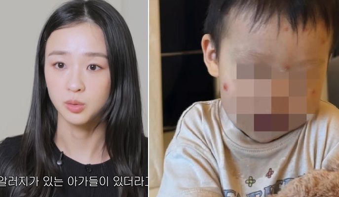심한 붓기에 고름까지… 손연재 어린 아들 앓은 '스키터 증후군'의 정체