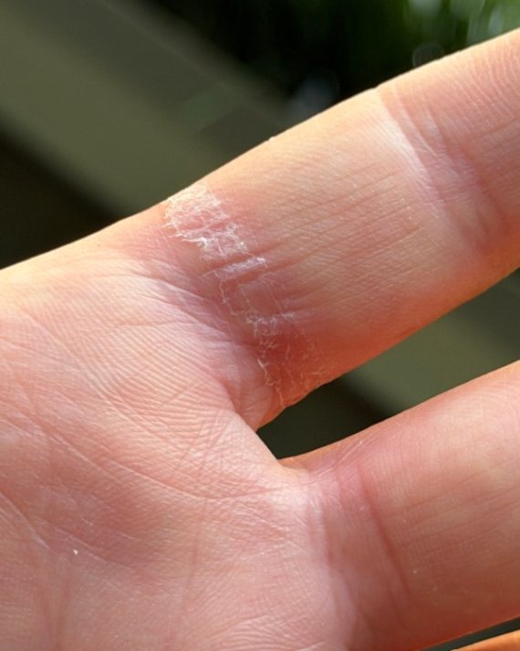 "손 부기 빼고 윤활제 발라 뺐다"…부풀어 오른 '갤럭시 링' 끝내