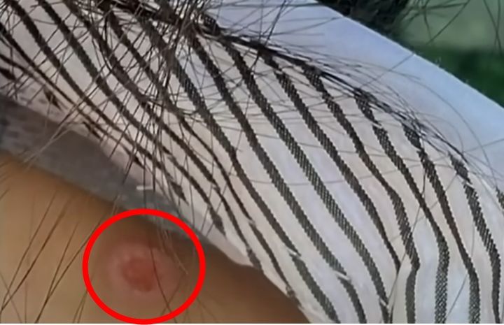 가해 남학생이 피해 여학생 몸에 새긴 담배빵 흔적 /사진=사건반장