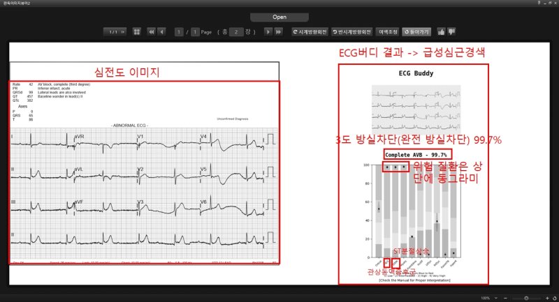 [서울=뉴시스] AI(인공지능) 심전도 분석 솔루션 'ECG 버디'를 사용한 그래프 모습. (사진= 분당서울대병원 제공)