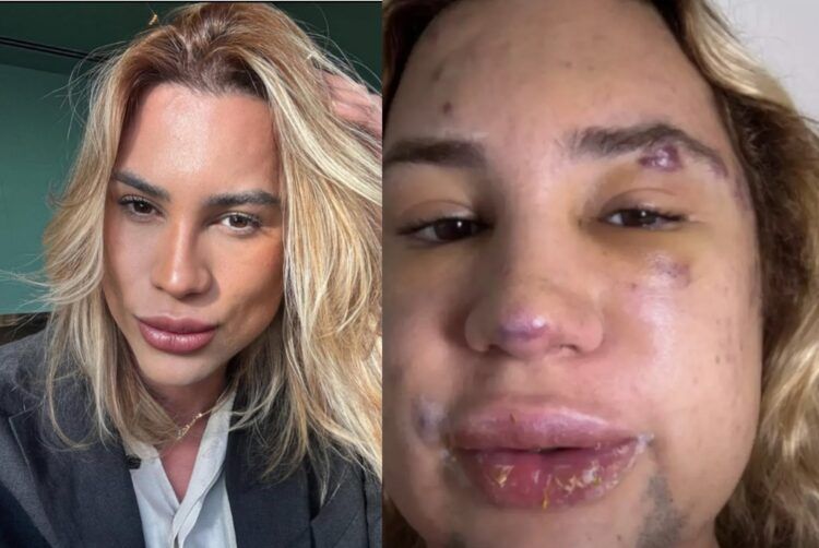 '여우 눈' 시술 받은 후 숨진 유명 인플루언서