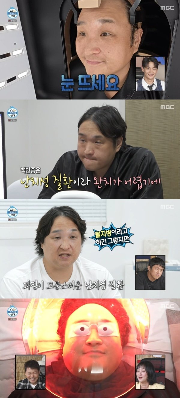 구성환, 난치성 질환 백반증 고통…부위 점점 넓어져 [RE:TV]