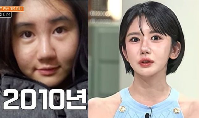 400번 성형에 3억 쓴 여성의 사연 이젠 마취 없이...