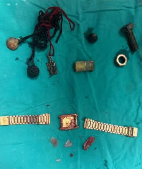 “밥도 못 먹을 만큼 아파” 병원 찾은 남성, 뱃속에서 나온 것은... 충격