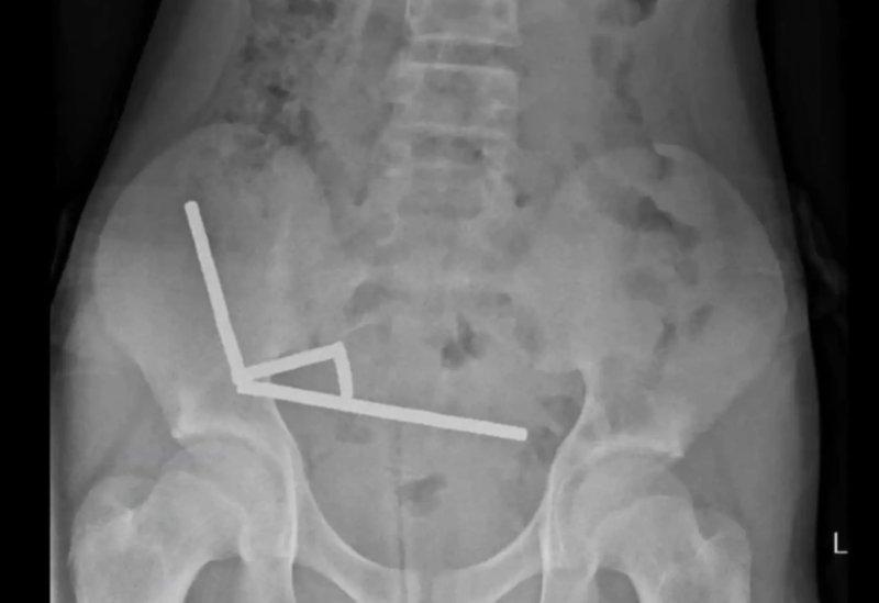[뉴시스] 엑스레이 촬영 결과 자석이 장 내에서 뭉쳐 인근 조직의 혈류를 차단한 것으로 나타났다. (사진=뉴욕포스트) 2025.10.24.