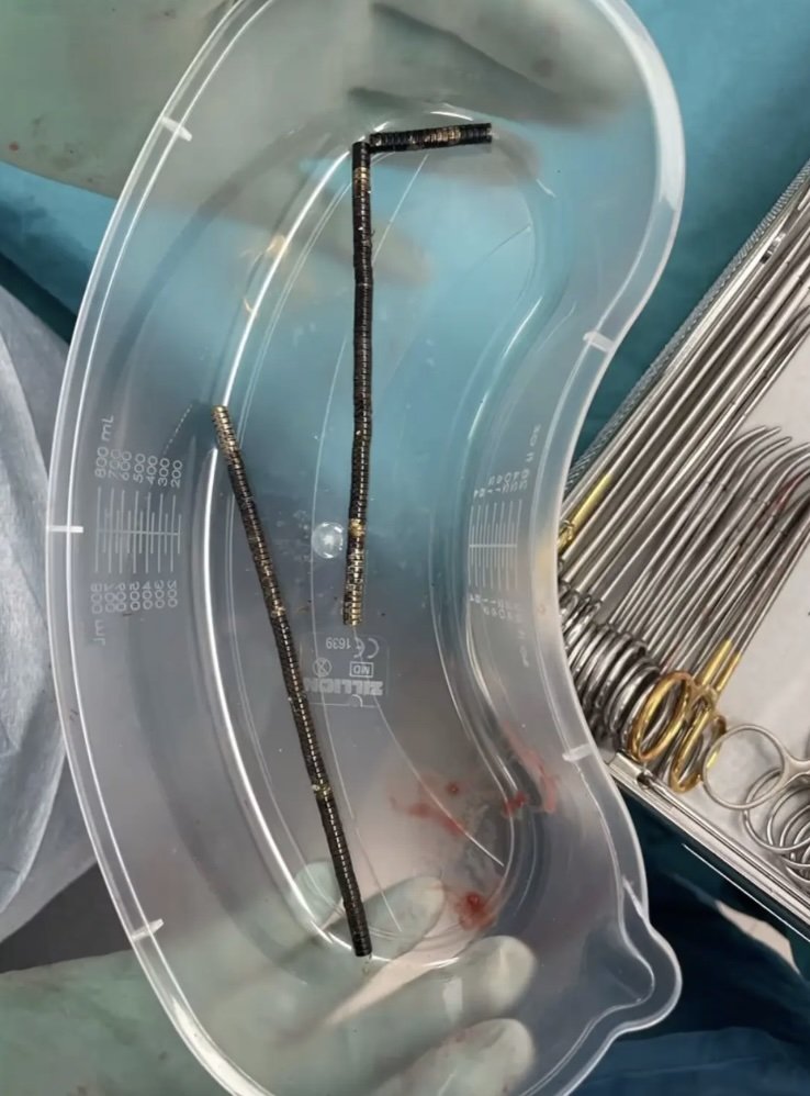 [뉴시스] 뉴질랜드 소년의 장에서 200여 개의 소형 네오디뮴 자석이 제거됐다. (사진=뉴욕포스트) 2025.10.24