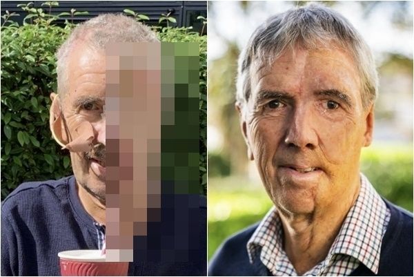 사고로 얼굴 절반 사라져…70대 남성, '안면 복구' 상황