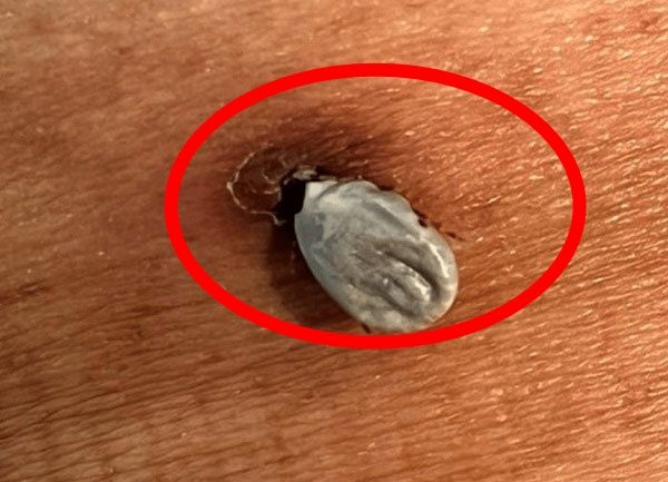 70대 남자, 한 달 동안 진드기 붙인 채... 희귀 사례