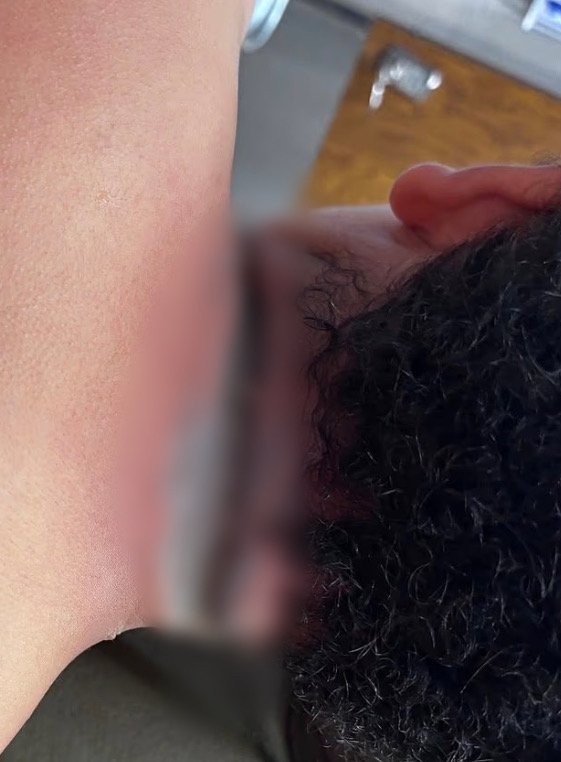 [서울=뉴시스] 미국에서 9세 소년이 침대에서 태블릿을 충전하던 중 목에 걸려 있던 금속 목걸이와 충전 케이블이 접촉하면서 감전돼 목과 왼손에 큰 화상을 입는 사고가 발생했다. (사진 = 뉴욕포스트 캡처) 2025.10.30. *재판매 및 DB 금지