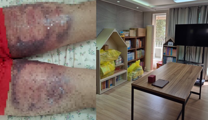 폭행을 당했다고 주장하는 경계선지능인 A 씨의 폭행 피해 사진(왼쪽)과 학대 의혹이 불거진 대안 가정