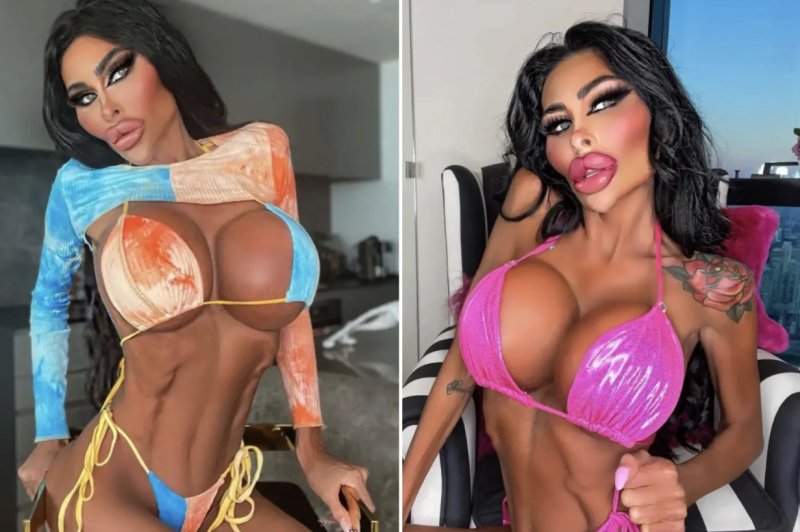 '인간 바비' 원한 성형 중독 여성, 1억 썼는데…충격적 비주얼