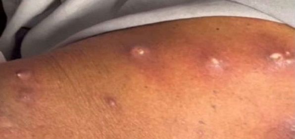 "널어둔 빨래에 알이…" 피부 파고들어 몸 속 감염 일으키는 벌레