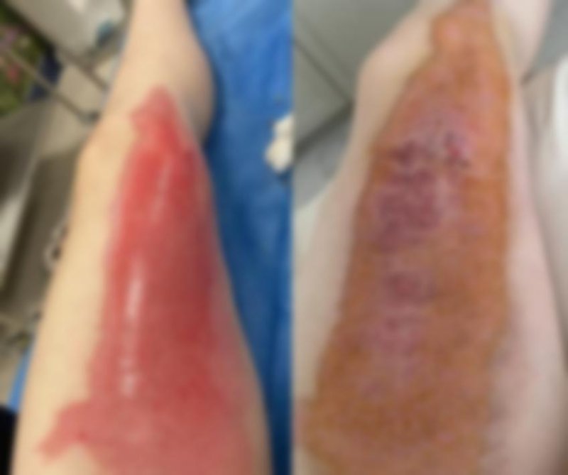 '겨울철 꿀템인데…' 20대女 온몸 큰 화상 입힌 '이 주머니'