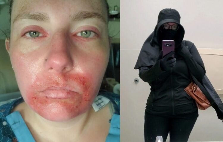 햇빛 노출 단 30초 만에 '3도 화상'…이 병 감염 후 더 악화됐다