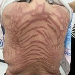 온몸에 ′뱀 무늬′ 생긴 女, 알고 보니 10년간 쓴 ′이것′ 때문이었다