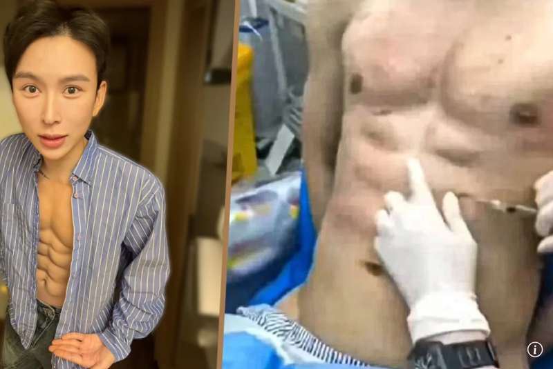 '에잇팩' 만들려고 필러 주입한 男, 쓴 돈이 무려..