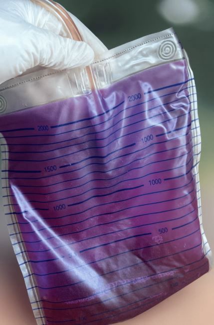 80대 女, 소변이 보라색?…이유 알고 봤더니  