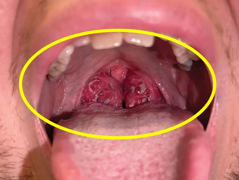 '키스병' 뭐길래…