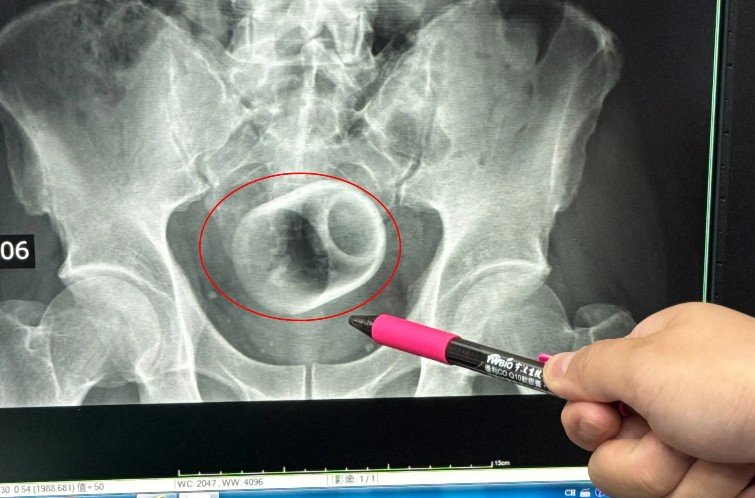 항문 속에 컵 들어간 男, 3일 동안.. 참혹