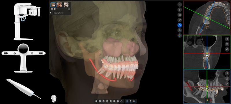 "5D 업그레이드" 레이, 구강스캔 자동정합 신기술 공개 - 뉴스 썸네일 이미지